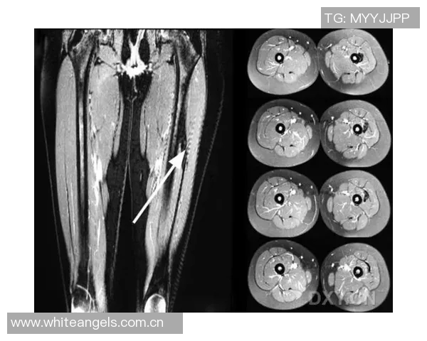 李磊右大腿后群肌肉拉伤及肌筋膜炎I的伤情报告分析与康复建议